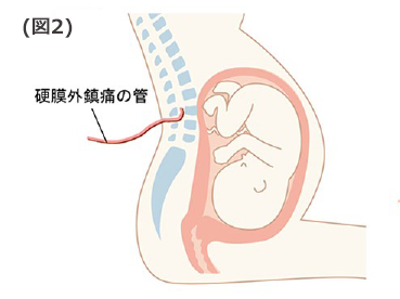 硬膜外沈痛の管、説明①