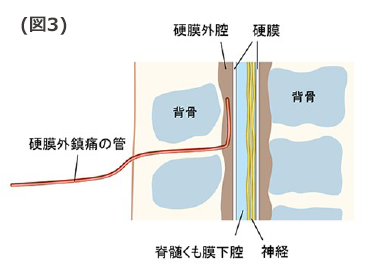 硬膜外沈痛の管、説明②
